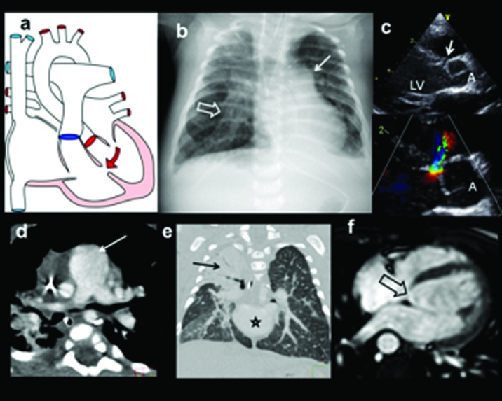 Ventricular septal defect diagram with echocardiographic and radiographic imaging