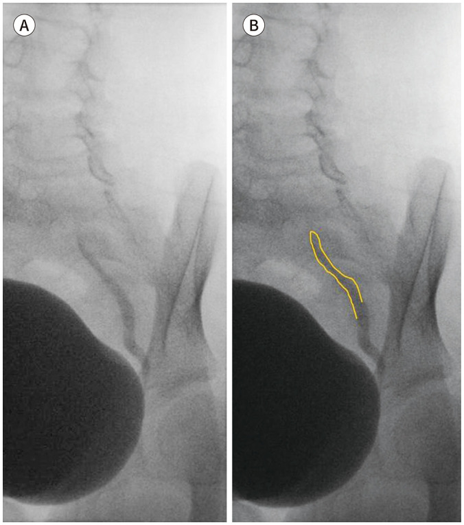 VCUG showing Grade I vesicoureteral reflux with reflux into non-dilated ureter only