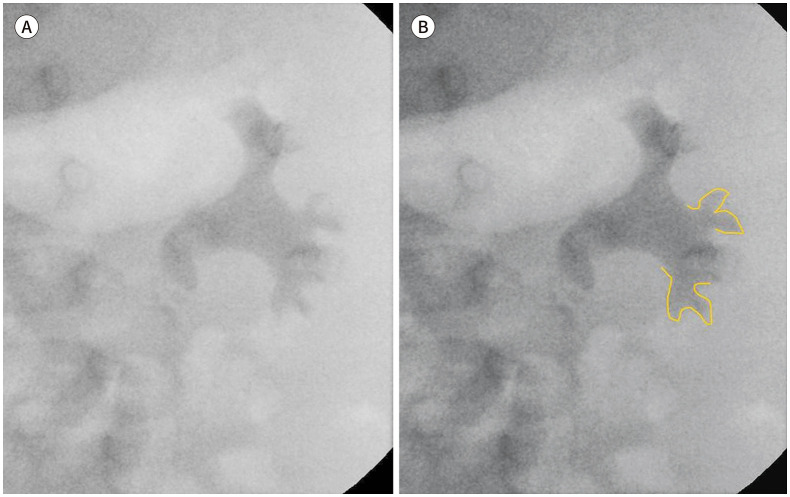 VCUG showing Grade III vesicoureteral reflux with mild to moderate ureteral and pelvicalyceal dilation