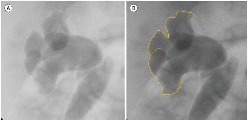 VCUG showing Grade V vesicoureteral reflux with gross dilation and tortuosity of the ureter