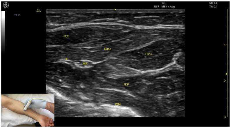 Ultrasound-guided anatomy of the flexor digitorum superficialis muscle for botulinum toxin injection in finger flexion spasticity