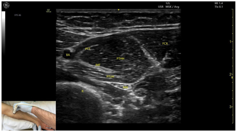 Ultrasound-guided botulinum toxin injection anatomy showing the pronator teres muscle with probe position and needle trajectory