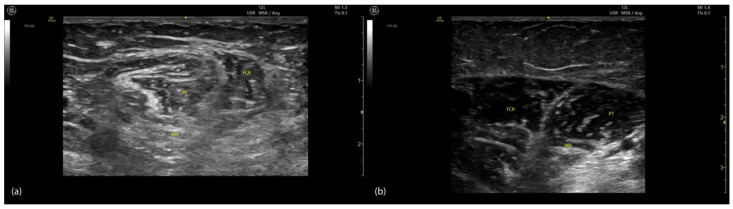 Ultrasound comparison of spastic versus normal muscle tissue showing differences in echogenicity and architecture