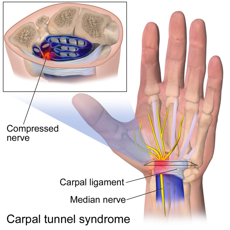 Cross-sectional anatomy of the carpal tunnel showing compression of the median nerve by the transverse carpal ligament