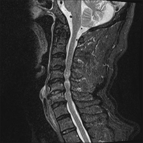 Sagittal T2-weighted MRI showing central cord syndrome with hyperintense signal in the cervical spinal cord following hyperextension injury