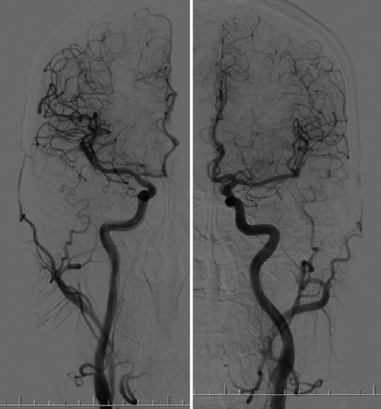 Anterior cerebral circulation showing major arterial territories including ACA, MCA, and PCA with angiographic views