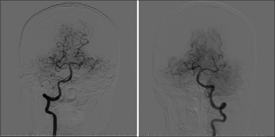 Posterior cerebral circulation showing vertebral arteries, basilar artery, and posterior cerebral arteries