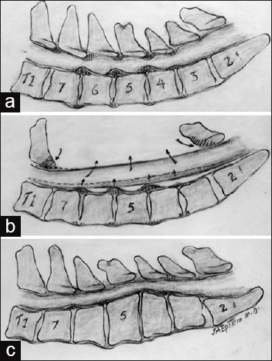 Illustration of surgical approaches for cervical spinal stenosis including anterior and posterior decompression techniques