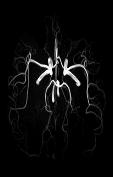 Circle of Willis diagram showing the arterial anastomotic ring at the base of the brain