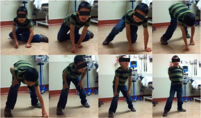 Illustration of Gowers sign in a young boy with Duchenne muscular dystrophy showing the characteristic maneuver of climbing up the legs to stand