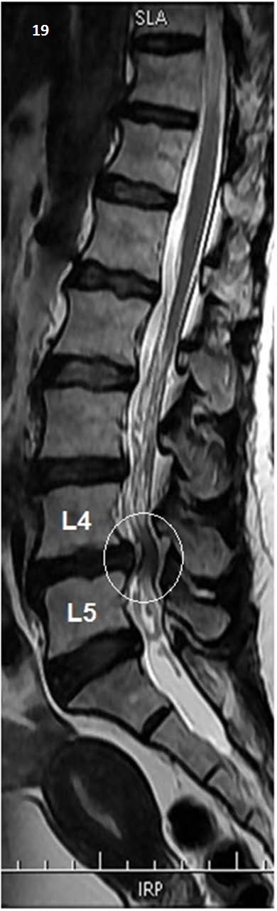 Sagittal T2-weighted MRI showing lumbar disc herniation with narrowing of the spinal canal at L4-L5