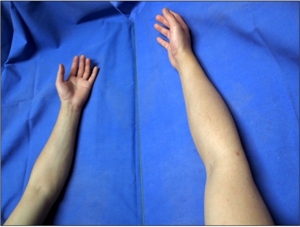 Patient performing mirror therapy for phantom limb pain, viewing the reflection of the intact limb in a mirror