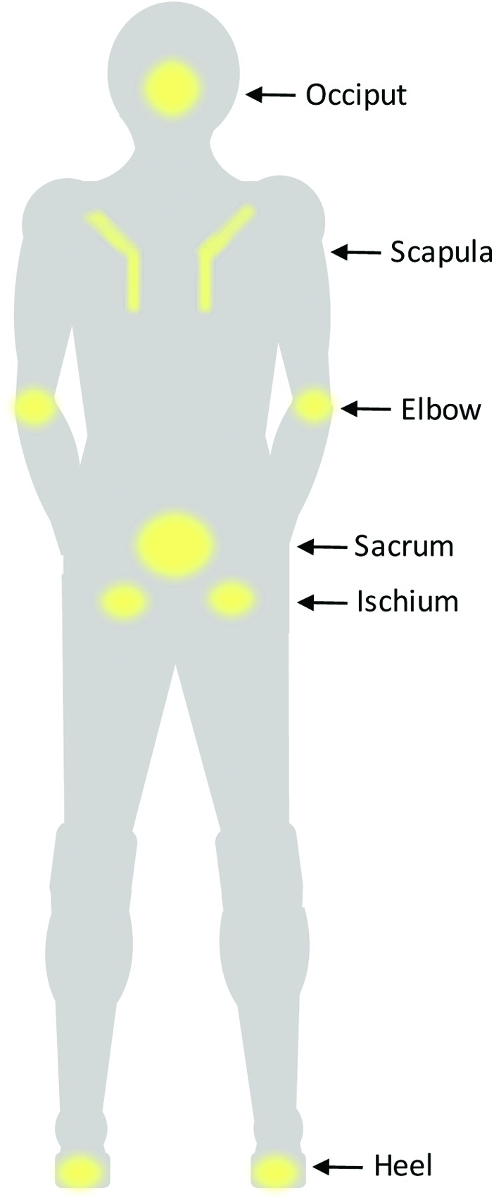 Anatomical diagram showing common pressure ulcer locations on a supine patient including sacrum, heels, occiput, and scapulae
