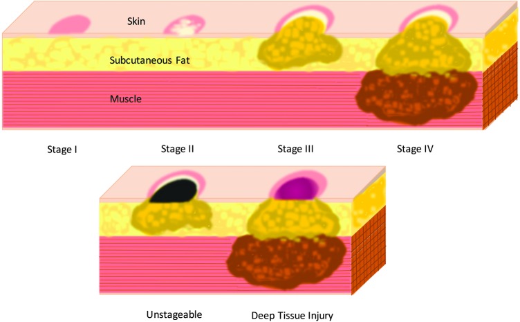 Illustration showing the different stages of pressure ulcers from Stage I through Stage IV, including unstageable and deep tissue injury