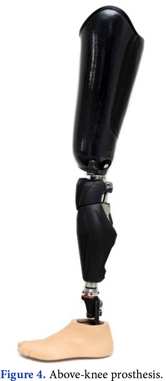 Components of a transfemoral (above-knee) prosthesis showing socket, prosthetic knee unit, pylon, and foot