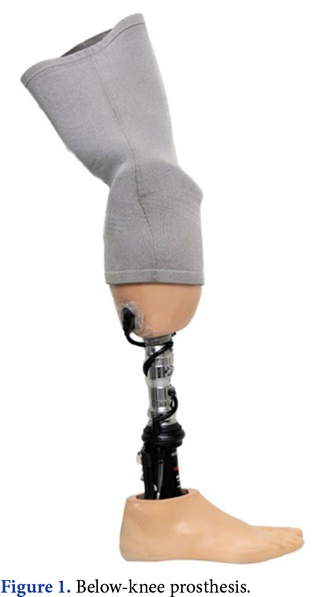 Components of a transtibial (below-knee) prosthesis showing socket, pylon, and prosthetic foot assembly