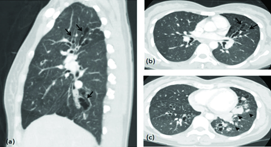 CT scan showing allergic bronchopulmonary aspergillosis with central bronchiectasis and mucoid impaction