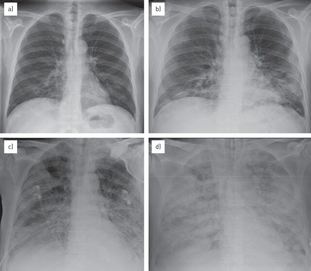 CT scan of ARDS showing dependent consolidation and non-dependent ground-glass opacities with anteroposterior density gradient
