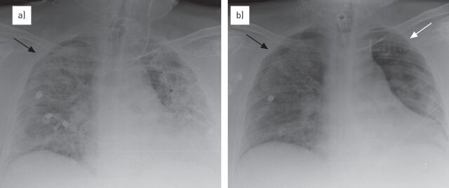 Chest radiograph and CT showing bilateral opacities characteristic of ARDS