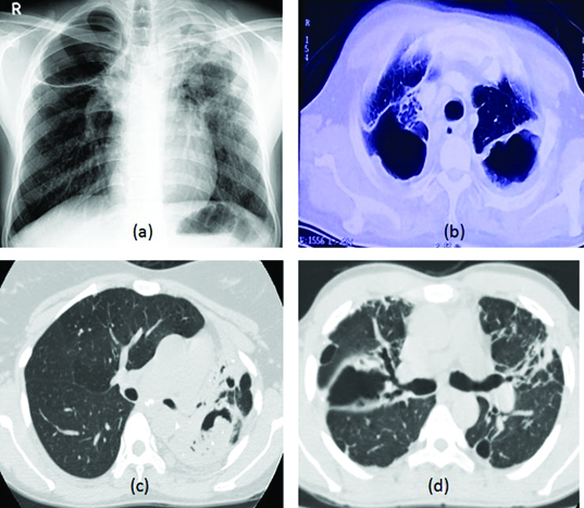 CT scan showing chronic pulmonary aspergillosis with cavitary changes and fungal ball