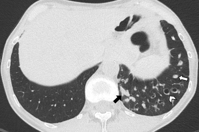 CT scan of the chest showing bronchiectasis and COPD changes including airway wall thickening and emphysematous destruction