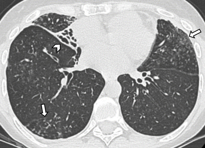 HRCT of the chest showing bronchiectasis with signet ring sign and dilated bronchi