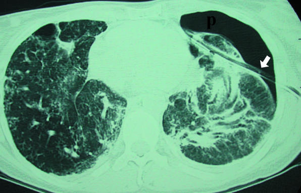 Chest radiograph showing proper chest tube placement in the pleural space