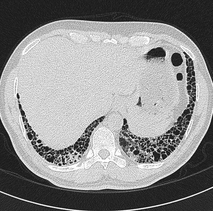 HRCT scan showing usual interstitial pneumonia pattern with honeycombing, traction bronchiectasis, and basal-predominant reticulation