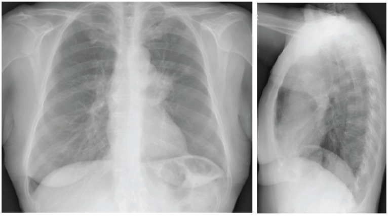 CT scan showing a lung cancer mass with characteristics of non-small cell lung cancer