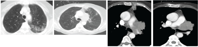 PET-CT scan showing FDG-avid lung cancer with mediastinal lymph node and distant metastases for staging