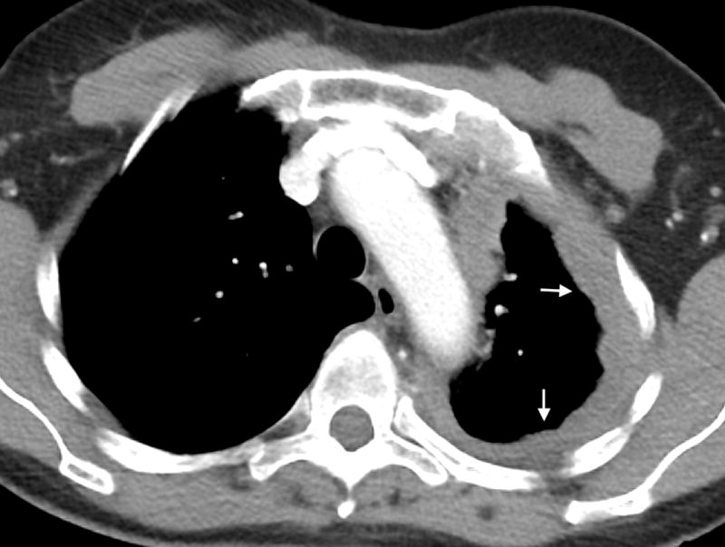 CT scan showing malignant pleural mesothelioma with nodular pleural thickening and pleural effusion