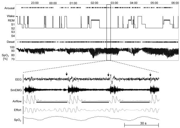 Polysomnography tracing showing recurrent obstructive apneas with oxygen desaturation in severe OSA