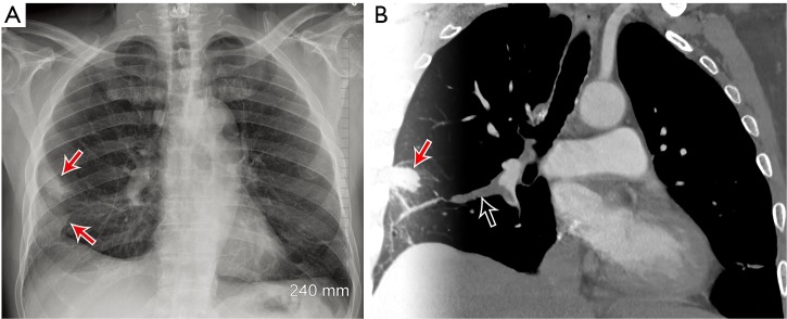 CT pulmonary angiography showing filling defects in the pulmonary arteries consistent with pulmonary embolism