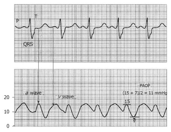 Right heart catheterization pressure waveform tracings showing elevated pulmonary artery pressures
