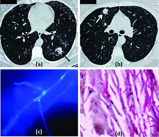 CT scan showing bilateral diffuse ground-glass opacities in Pneumocystis jirovecii pneumonia