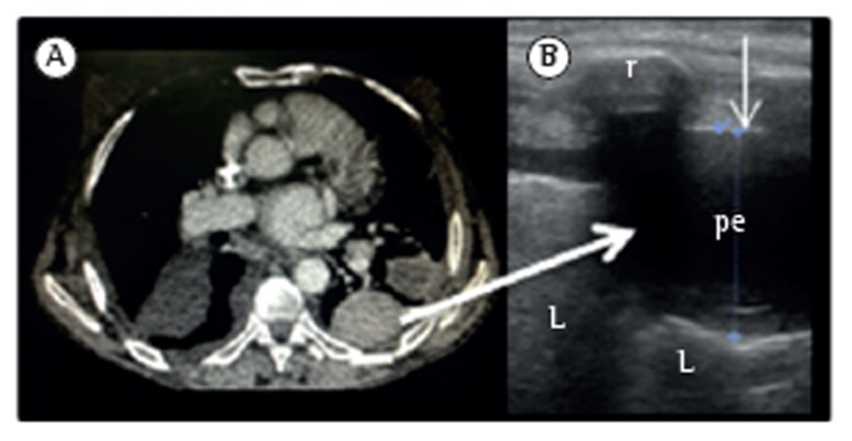 CT scan and ultrasound showing loculated pleural effusion with septations