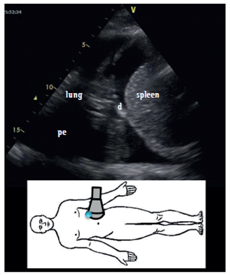 Ultrasound image demonstrating pleural effusion with anechoic fluid between the lung and chest wall