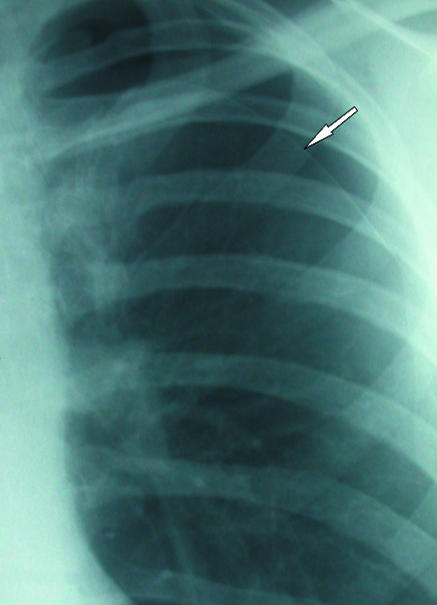 Chest radiograph demonstrating a pneumothorax with visible visceral pleural line and absent lung markings