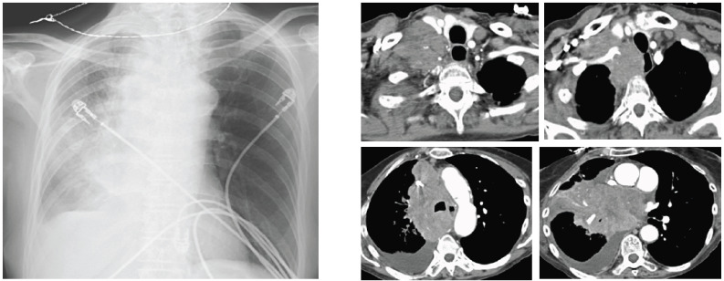 CT scan showing small cell lung cancer with central mass and bulky mediastinal lymphadenopathy