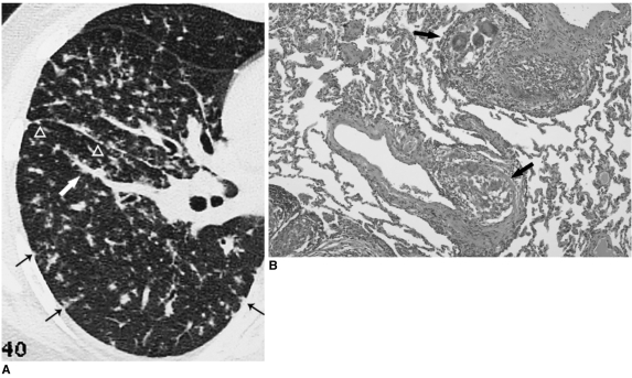 CT imaging of occupational lung disease showing features of asbestosis and silicosis including pleural plaques and nodular opacities