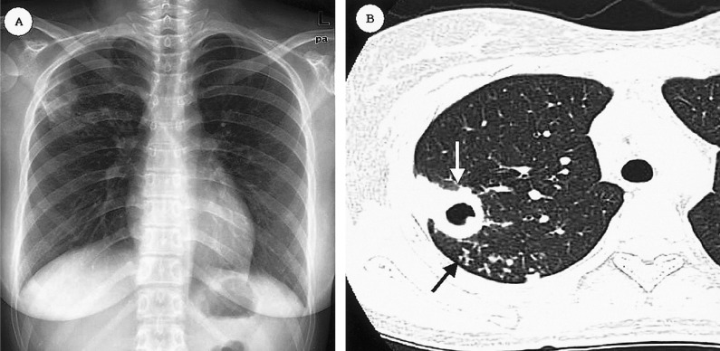 Chest radiograph and CT showing cavitary tuberculosis in the right upper lobe