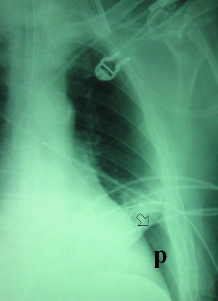 Chest radiograph showing tension pneumothorax with mediastinal shift to the contralateral side