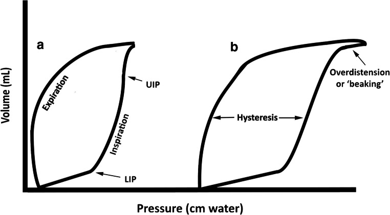 Pressure-volume loop demonstrating overdistension, optimal PEEP, and atelectasis zones