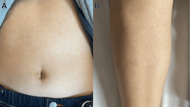 Clinical photograph showing the evanescent skin rash of Adult-Onset Still Disease on the trunk and extremities with macular and maculopapular lesions