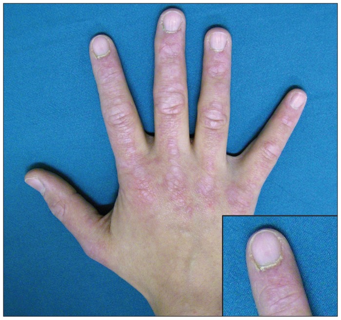 Clinical photograph of Gottron papules on the hands showing violaceous papules over the metacarpophalangeal and proximal interphalangeal joints with periungual capillary dilatation