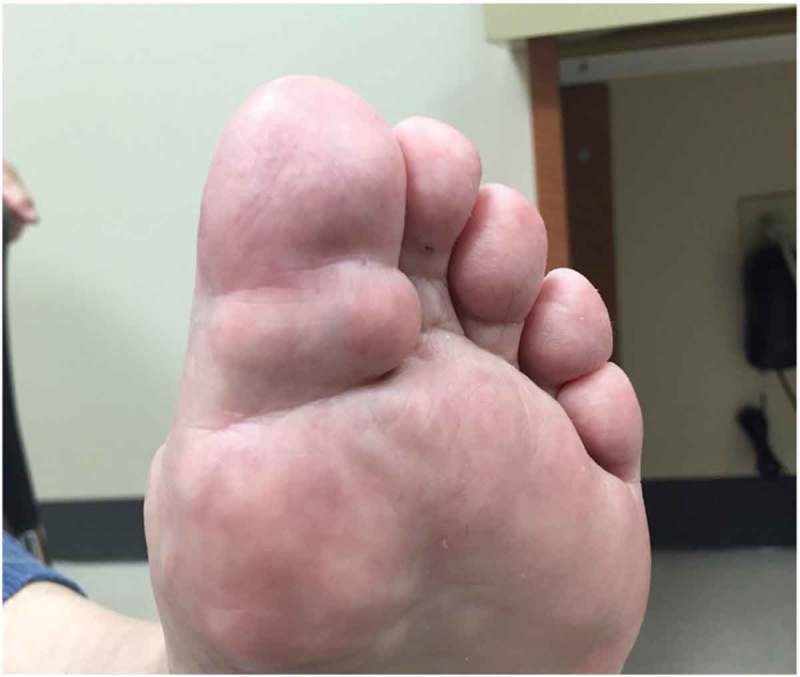 Clinical photograph showing a gouty tophus at the plantar surface of the first metatarsal joint with chalky white urate deposits visible beneath the skin