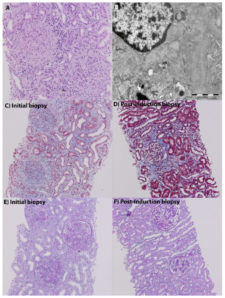 Renal biopsy histopathology of lupus nephritis showing proliferative glomerulonephritis with crescent formation and immune complex deposits