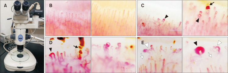 Nailfold capillaroscopy patterns showing normal, early, active, and late scleroderma patterns with dilated capillaries and dropout areas