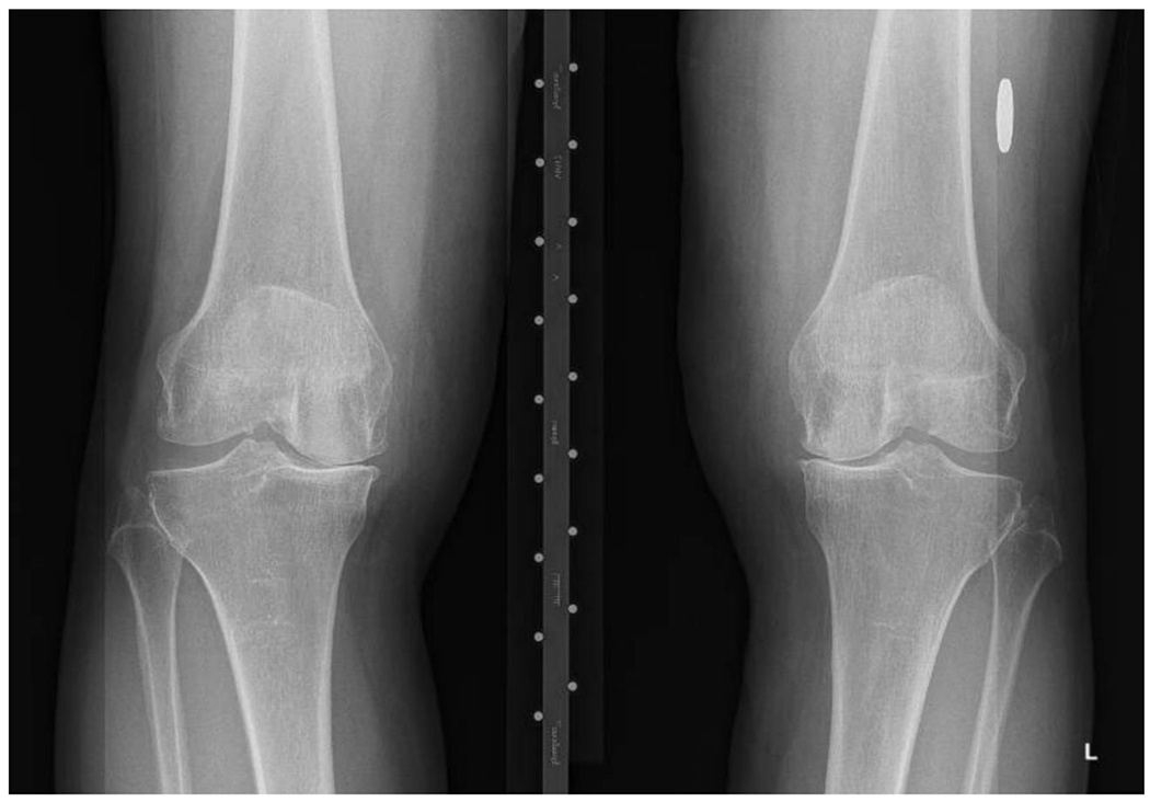 Bilateral knee radiograph showing severe osteoarthritis with varus deformity, medial joint space narrowing, subchondral sclerosis, and osteophyte formation