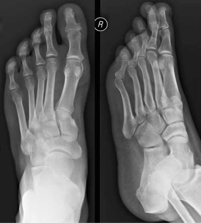 Foot radiograph in psoriatic arthritis showing ivory phalanx, erosive changes at interphalangeal joints, and periosteal reaction